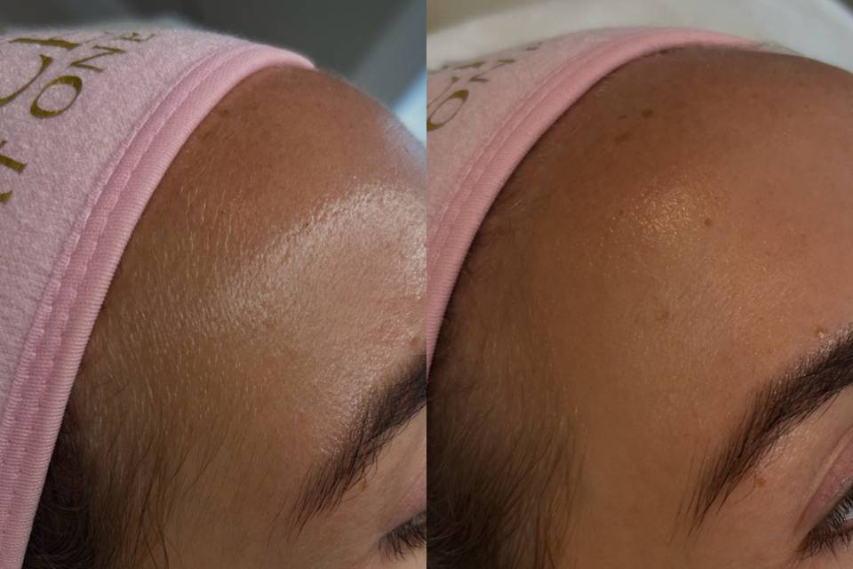 Before and after dermaplaning