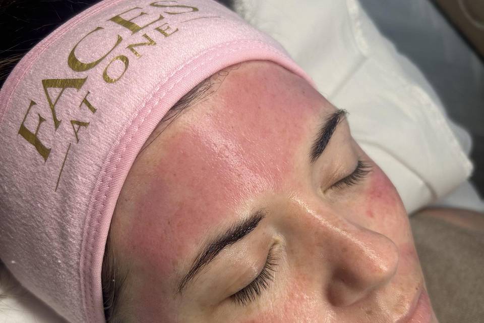 Microneedling