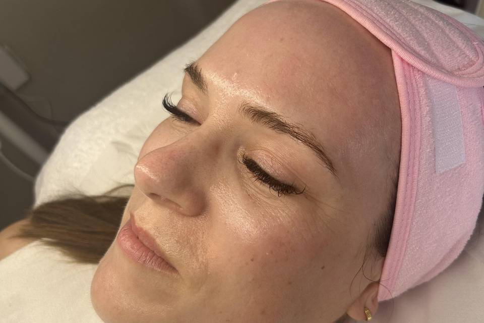 Microneedling