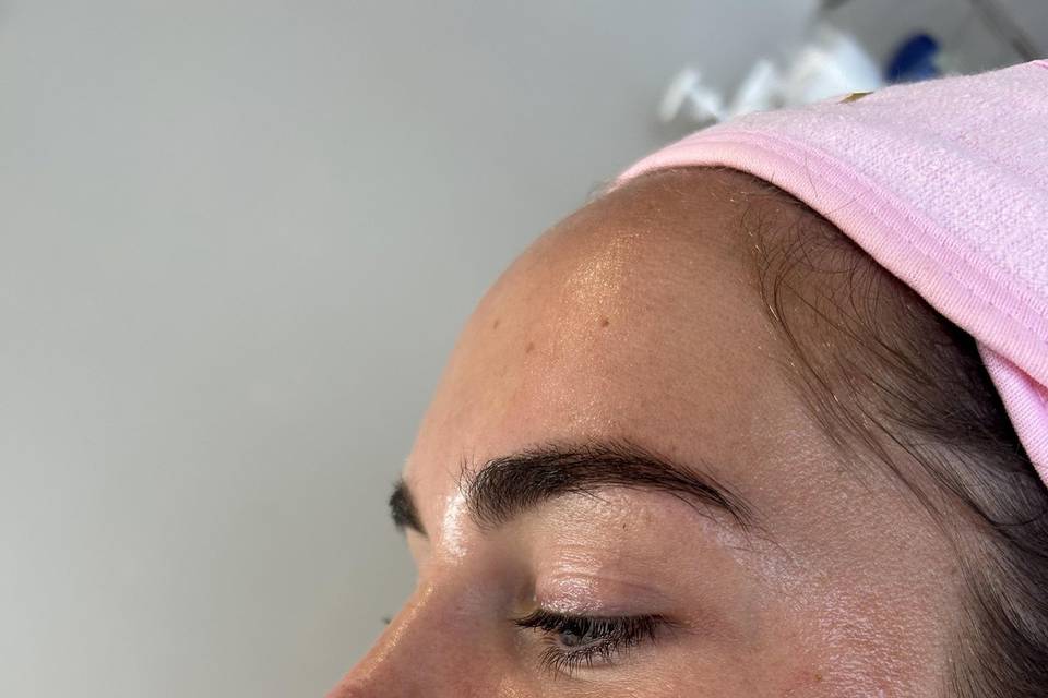 Dermaplaning