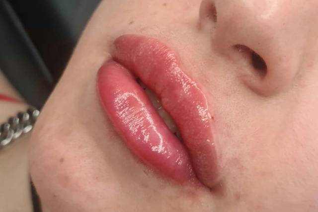 Lip fillers