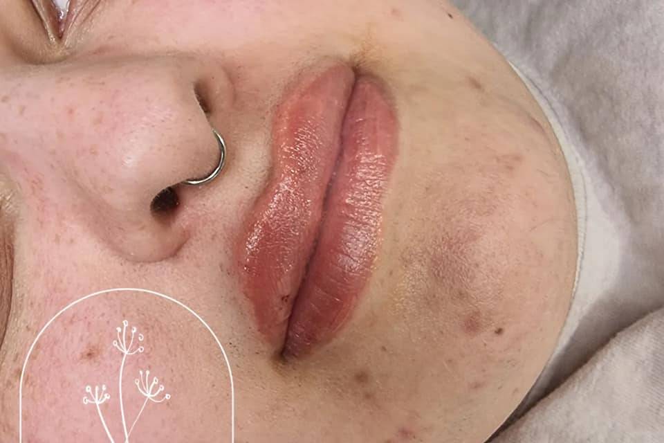Dermal Lip Filler.