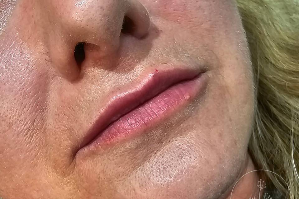 Dermal Lip Filler.