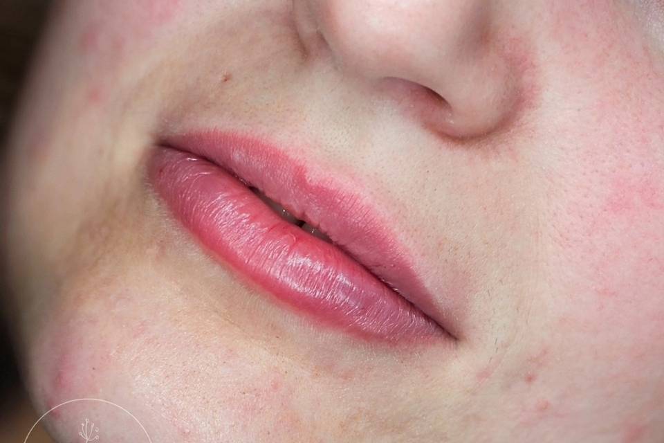 Dermal Lip Filler.