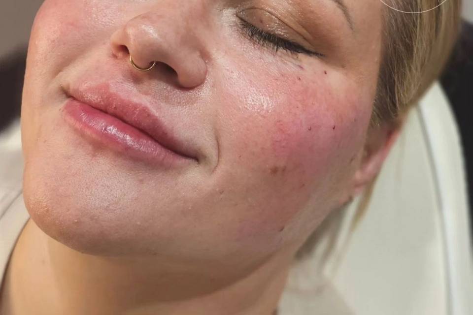 Dermal 8-Point Lift Filler.