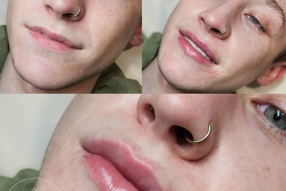 Dermal Lip Filler.