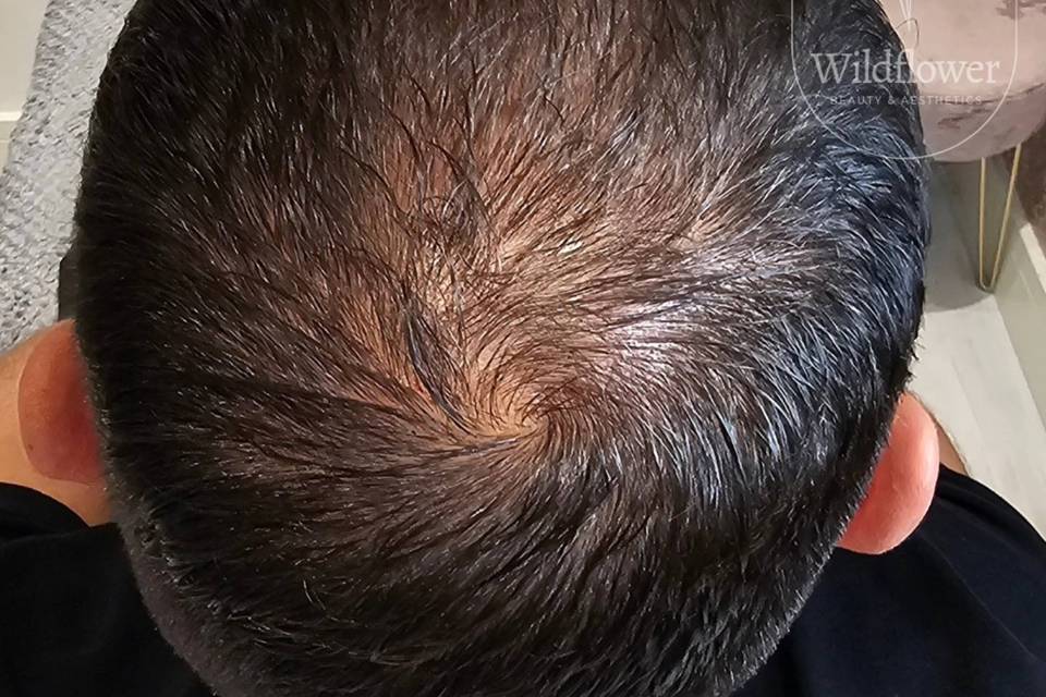 Hair Loss Treatment.