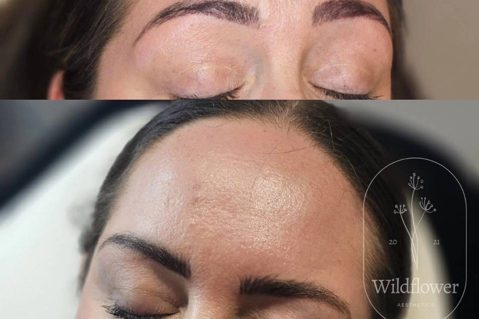 Anti-Wrinkle Treatment.