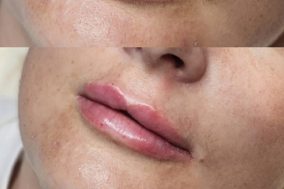Dermal Lip Filler.