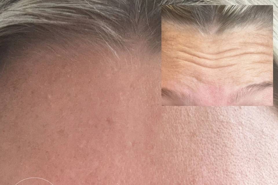 Anti-Wrinkle Treatment.