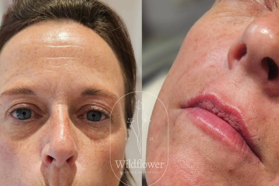 Dermal Marionette Filler.