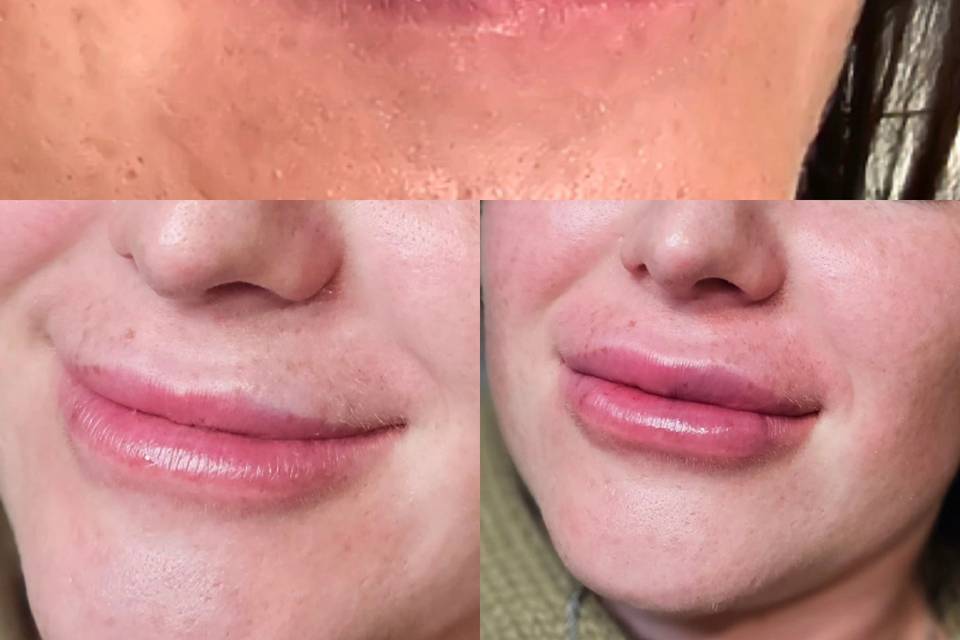 Elective Filler Dissolve.