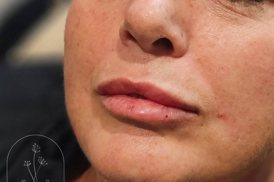 Dermal Lip Filler.