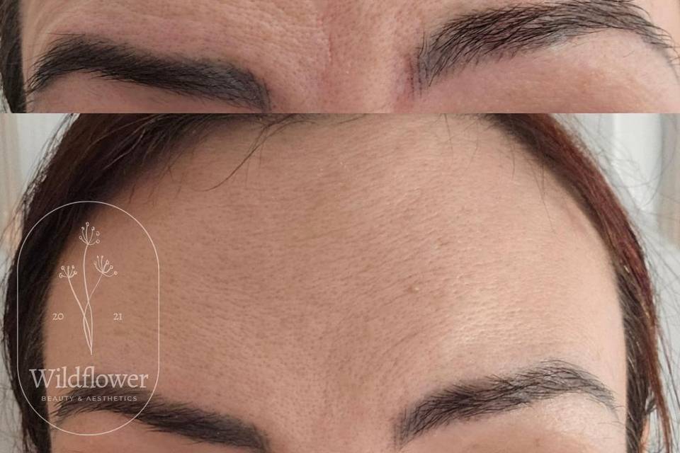 Anti-Wrinkle Treatment.