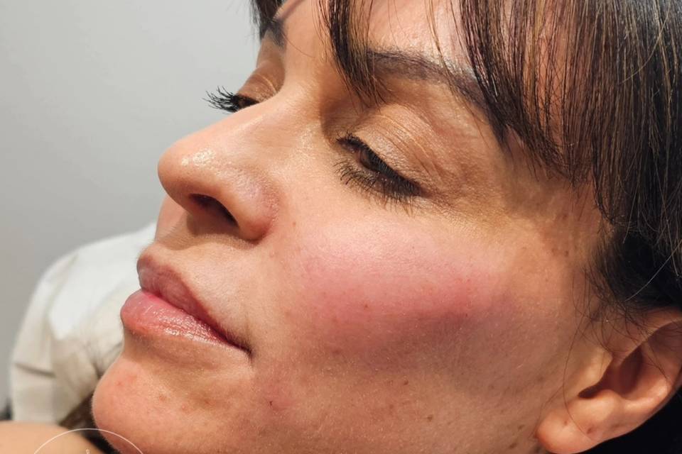 Dermal 8-Point Lift Filler.