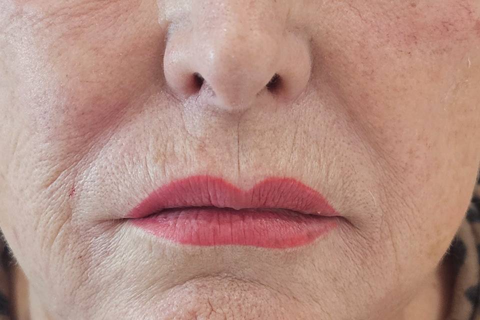 Dermal Marionette Filler.