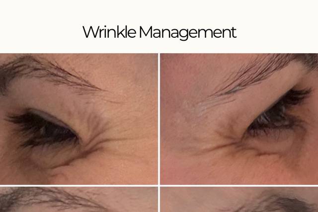 Wrinkle Management