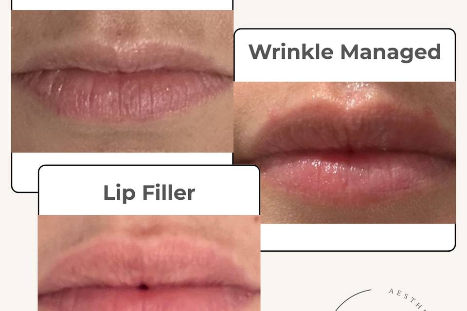 Lip Management