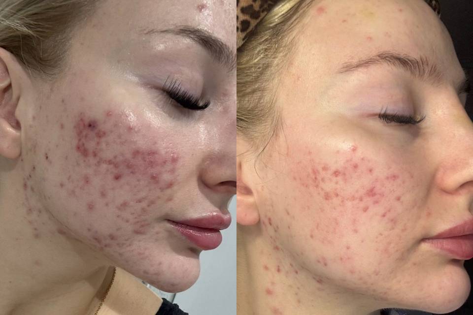 Acne treaments