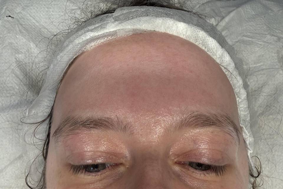 Hydrofacial