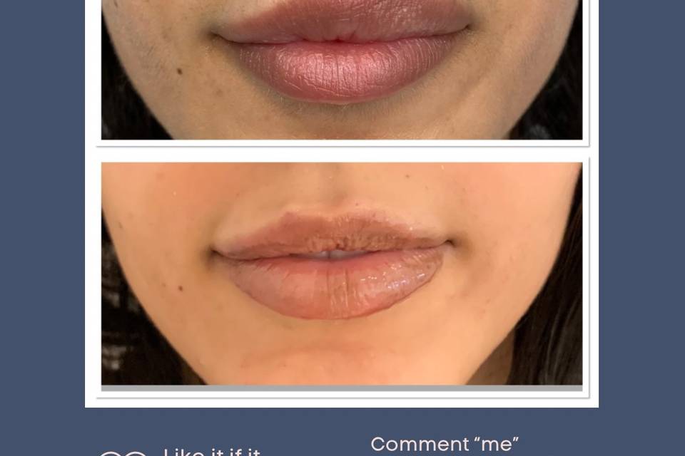 Before/after lip correction