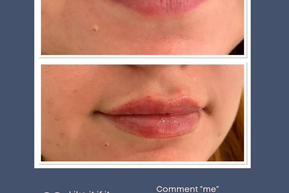 Plump lips