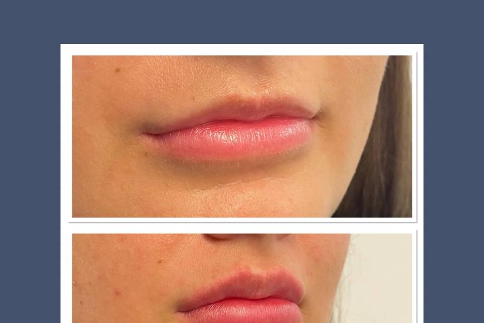 Plump lips