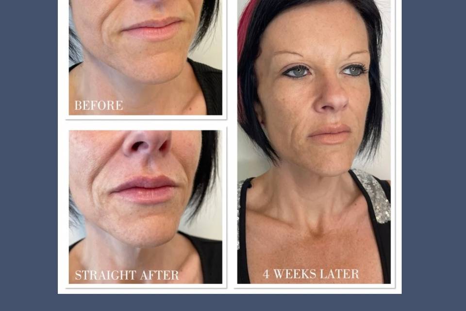 Cheek filler treatment