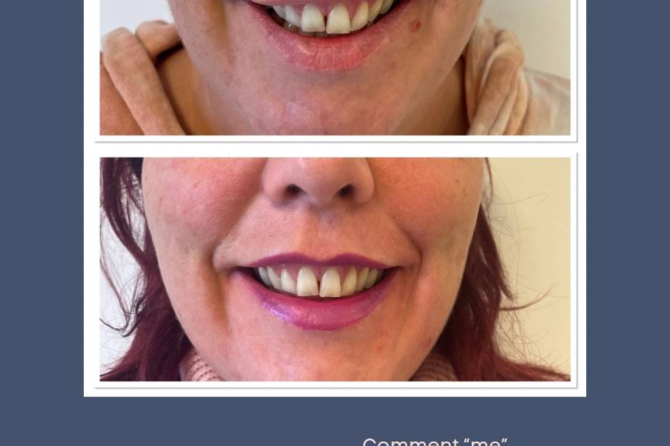 Reduction of asymmetry and gum
