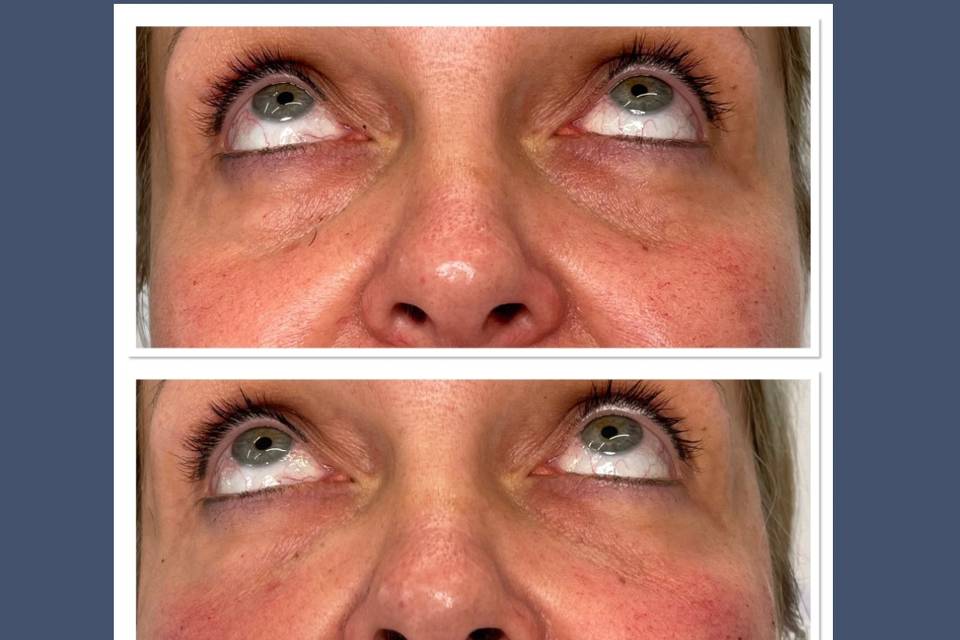 Tear trough treatment