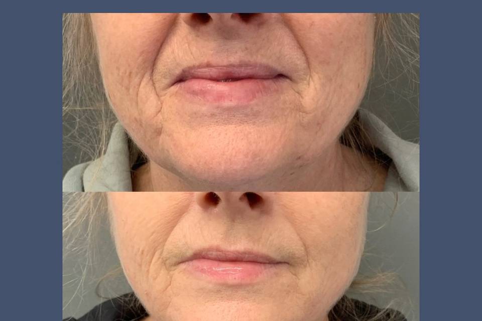 Chemical face peel for crepey