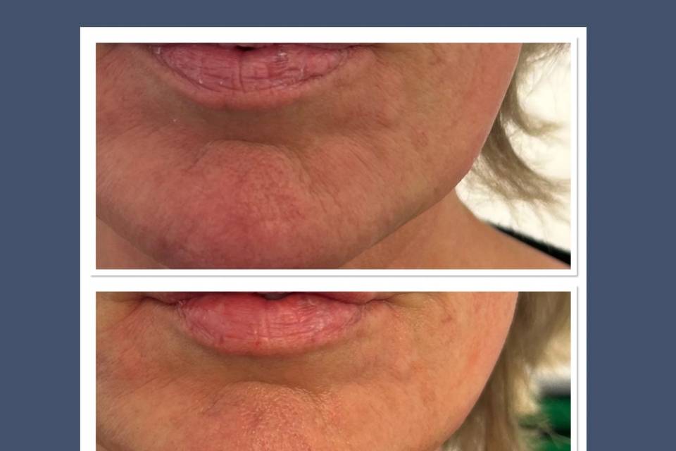 Reduction of crepey skin