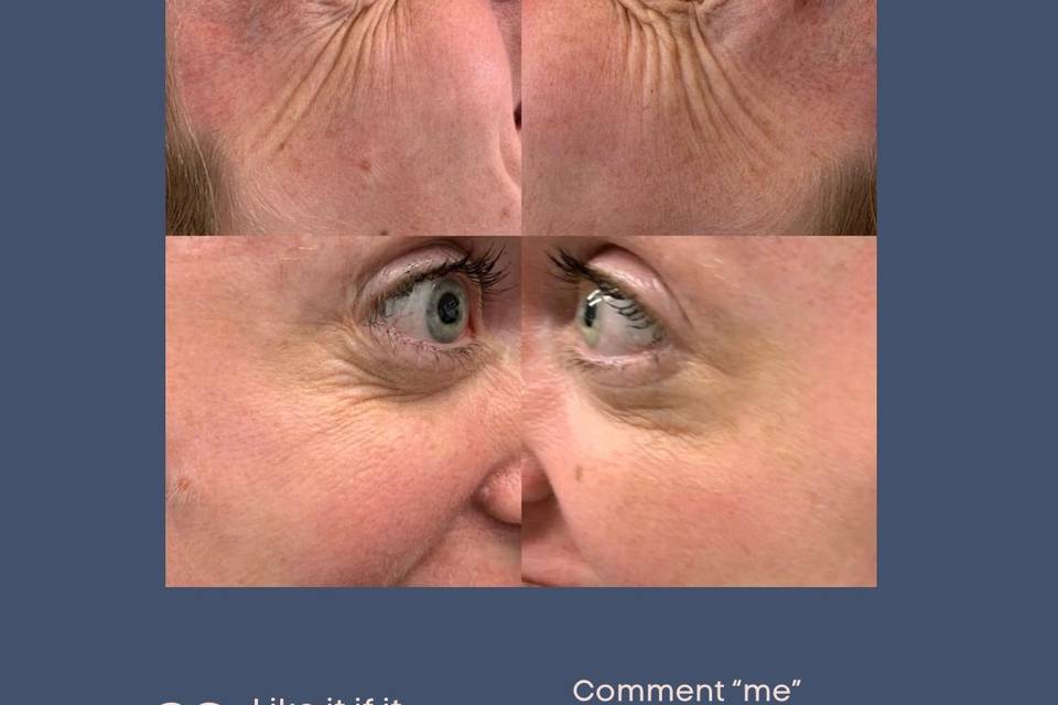 Toxin treatment