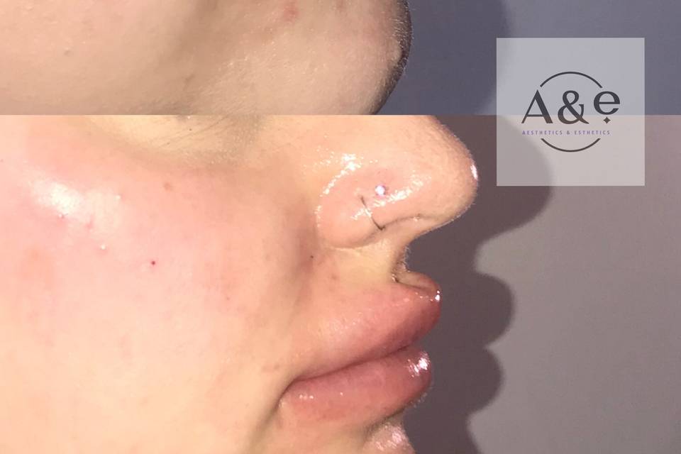 Side profile lip filler