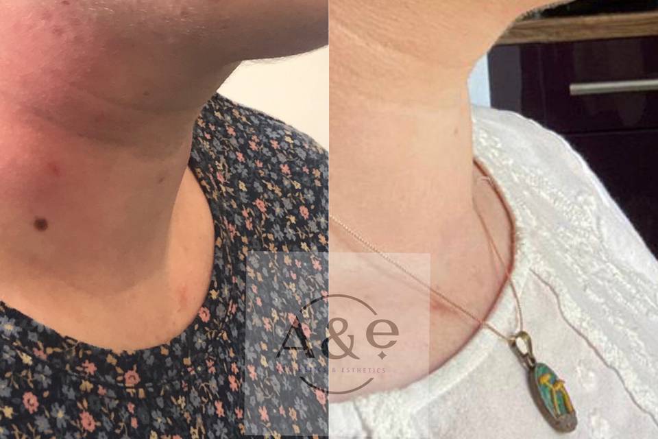 Neck fat dissolving before and after