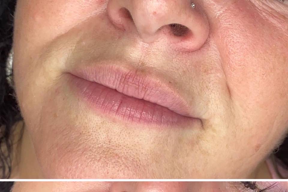 Lip filler