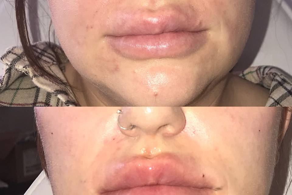 Lip filler