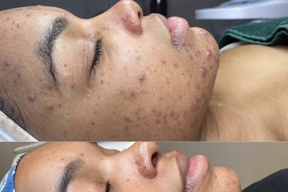 Acne/pigmentation