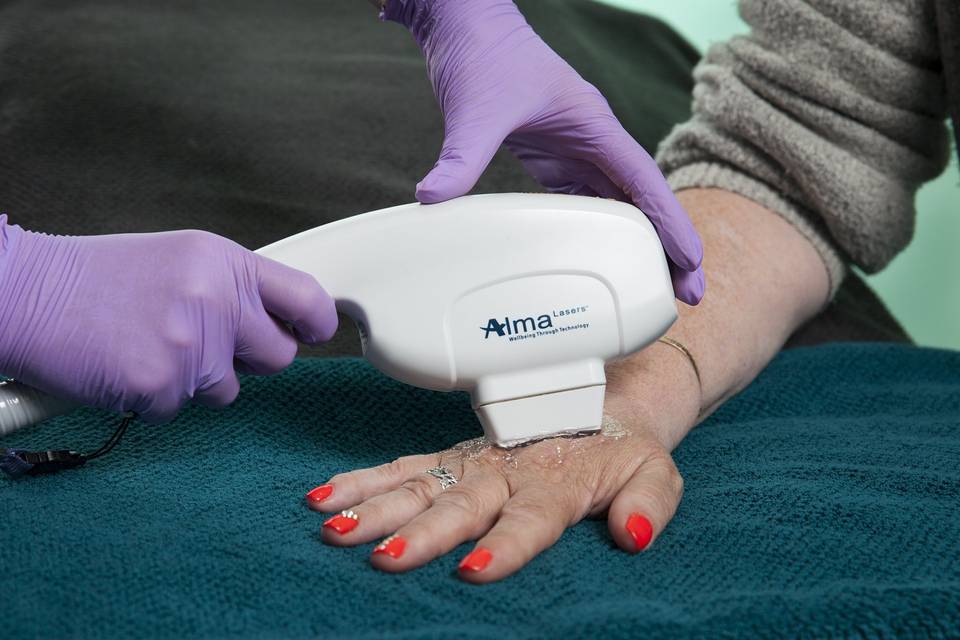 Age spot treatment